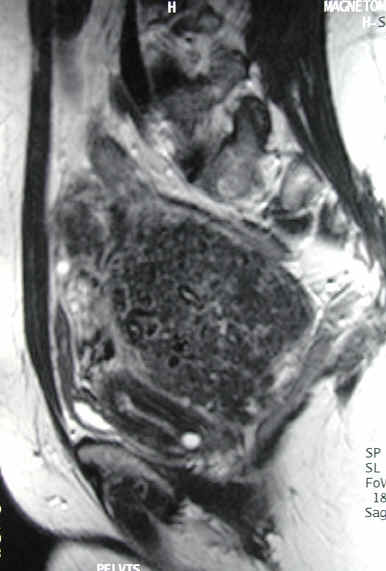 on MRI evaluation, the fibroid was shown to be peduncluated, or hanging on a stalk, behind the uterus