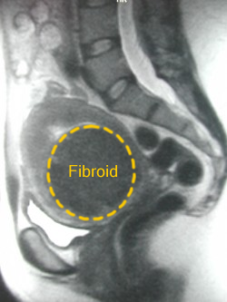 MRI showing sub-mucosal uteroid fibroid befre treatment