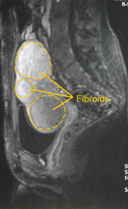 MRI with enhancement showing fibroids